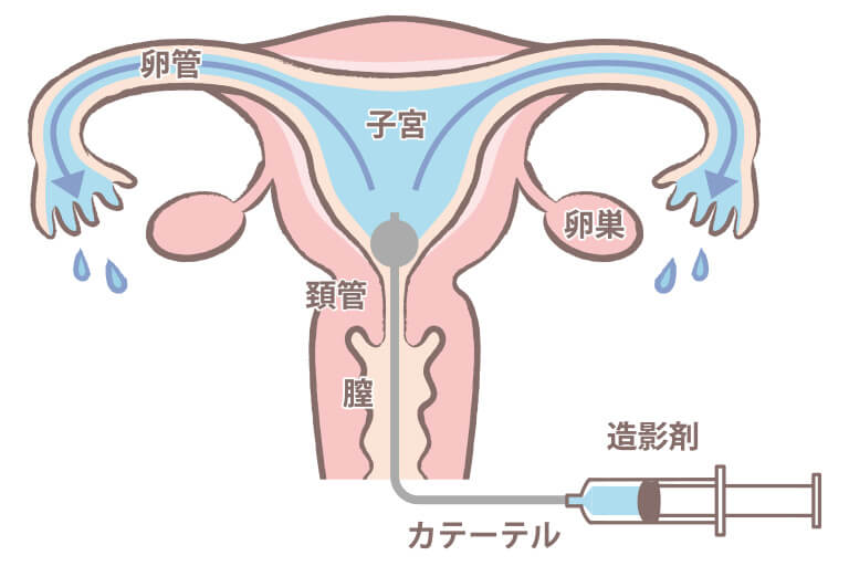 子宮卵管造影検査